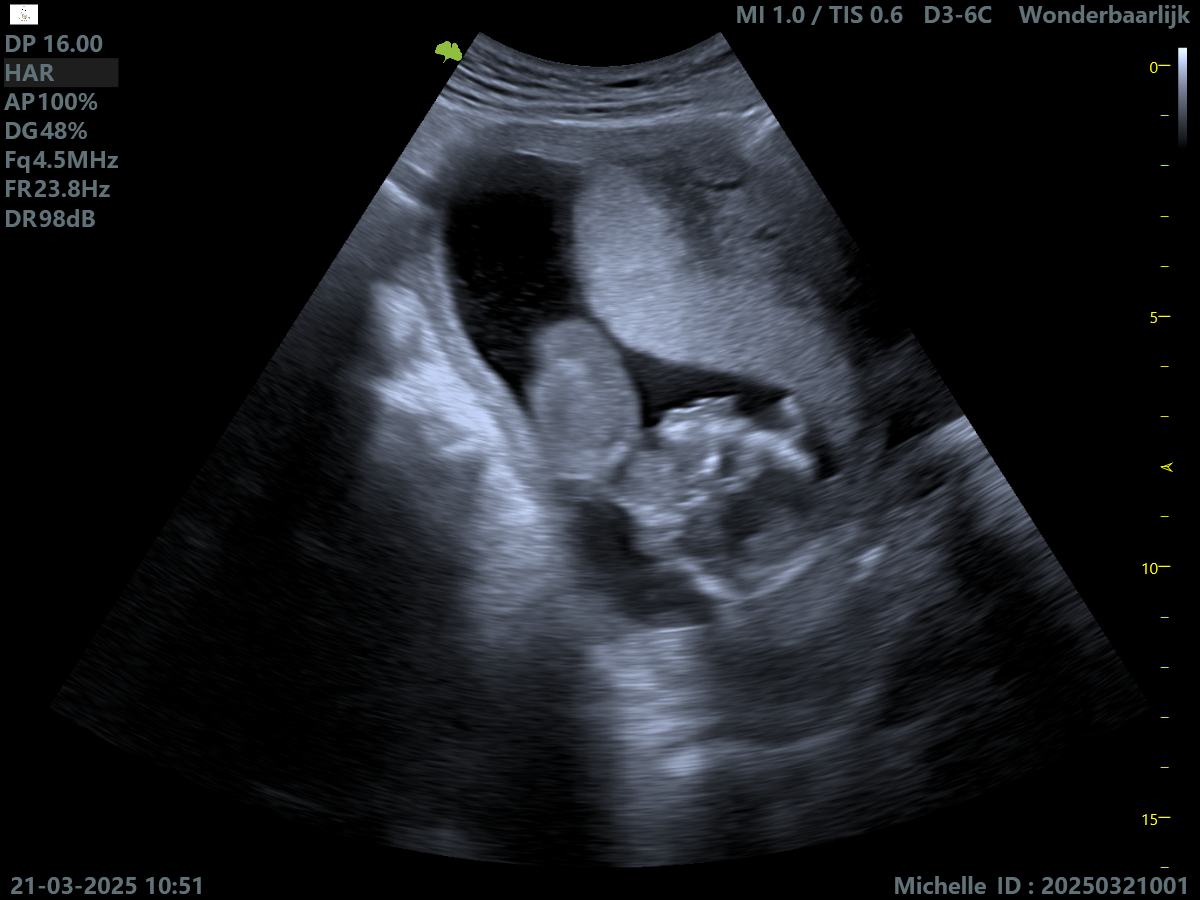 2D-echobeeld van een baby tijdens een pretecho